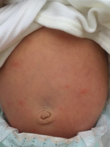 ファムズベビー乳児湿疹 (1)