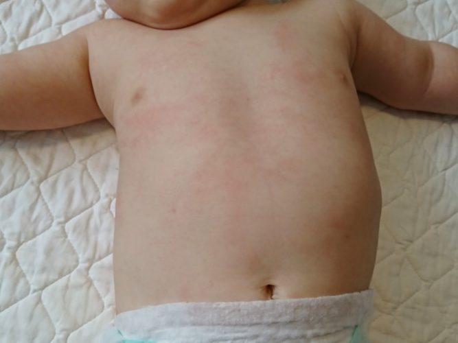 ファムズベビー乳児湿疹 (7)